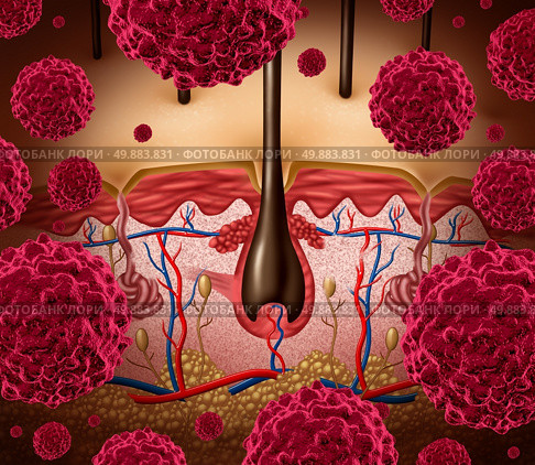 Skin cancer and melanoma medical concept as a human epidermis anatomy being attacked by malignant cancerous cells. Стоковое фото, агентство Ingram Publishing / Фотобанк Лори
