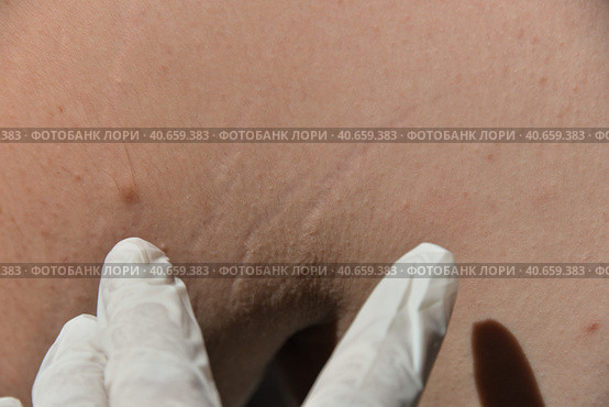 Skin diseases irritation, itching, cracked wounds lead to painful sensations. The skin may grow papillomas, warts, moles, white and dark spots will appear. Стоковое фото, фотограф Юлия Можина / Фотобанк Лори