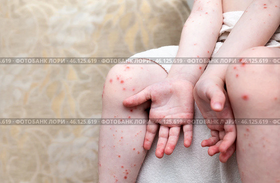Skin rash on the legs and arms of a young child. Стоковое фото, фотограф Дмитрий Кобзев / Фотобанк Лори
