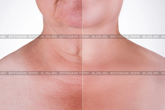 Skin rejuvenation on the neck, before after anti aging concept, wrinkle treatment, facelift and plastic surgery. Стоковое фото, фотограф Станислав Тарко / Фотобанк Лори