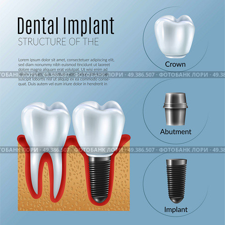 Structure of dental prosthetics infographics poster with denture near healthy tooth crown abutment implant realistic icons vector illustration. Realistic Dental Implant Infographics. Стоковая иллюстрация, агентство Ingram Publishing / Фотобанк Лори