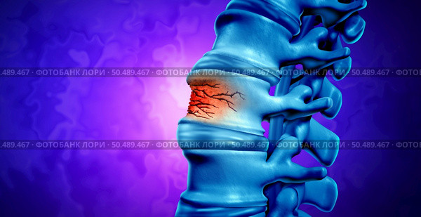 Traumatic Spine Fracture and vertebral injury medical concept as a human anatomy spinal column with a broken burst vertebra due to compression or other osteoporosis back disease as a 3D illustration. Стоковое фото, агентство Ingram Publishing / Фотобанк Лори
