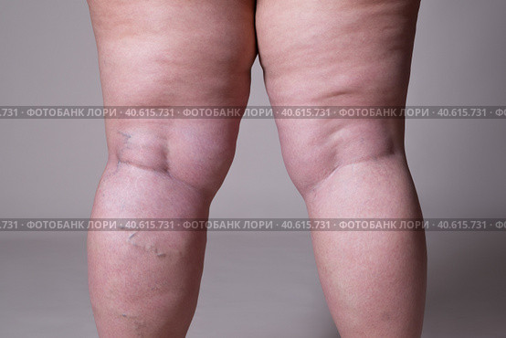Varicose veins closeup, fat female cellulite legs. Стоковое фото, фотограф Станислав Тарко / Фотобанк Лори