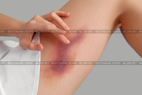 Young woman with bruised leg on grey background, closeup. Стоковое фото, фотограф Pixel_shot / Фотобанк Лори