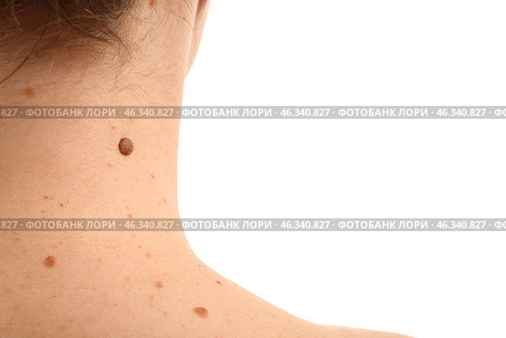 Young woman with moles on white background, closeup. Стоковое фото, фотограф Pixel_shot / Фотобанк Лори